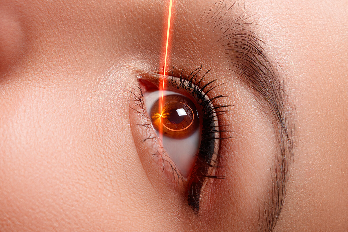 Chirurgie réfractive