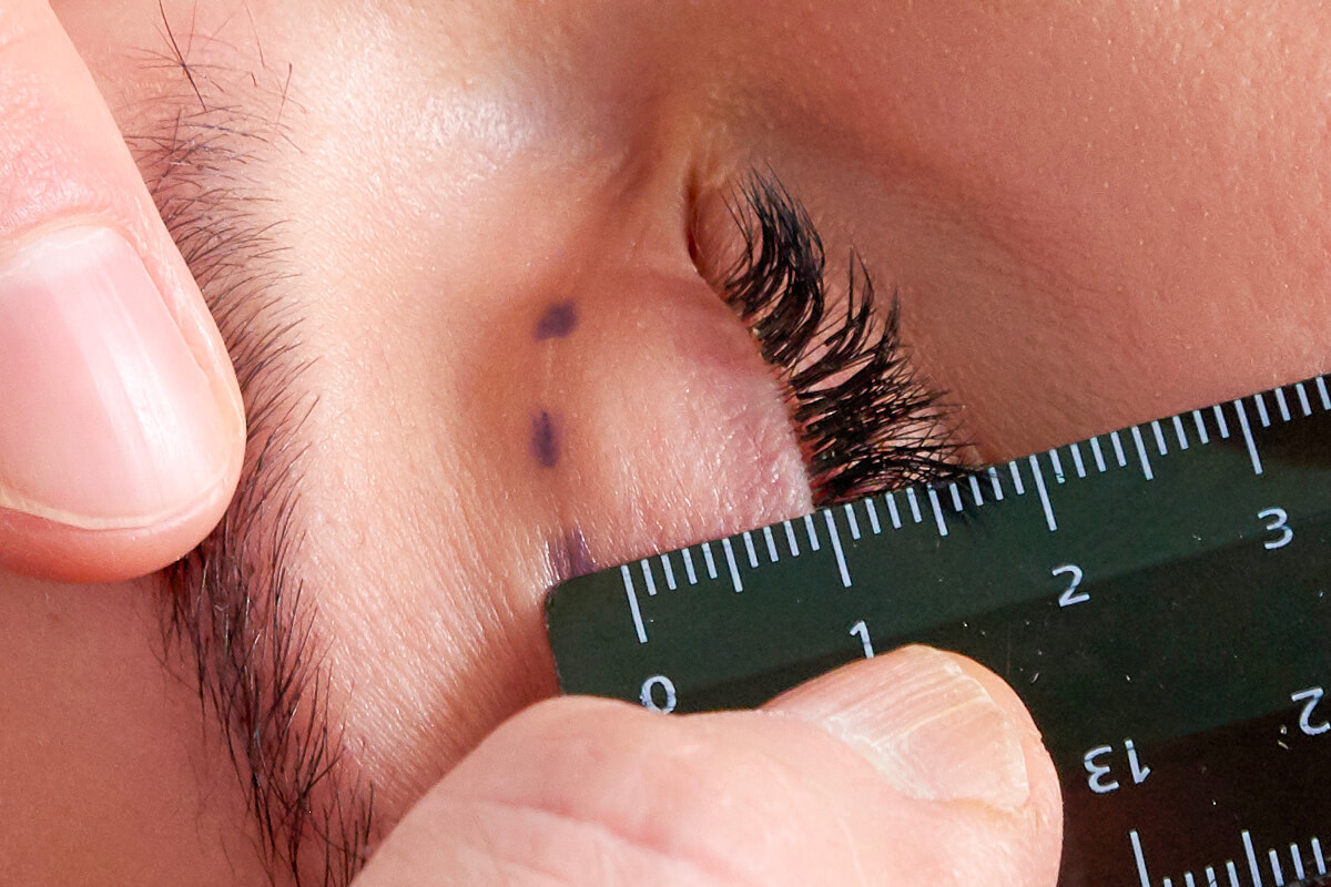 Chirurgie de la paupière