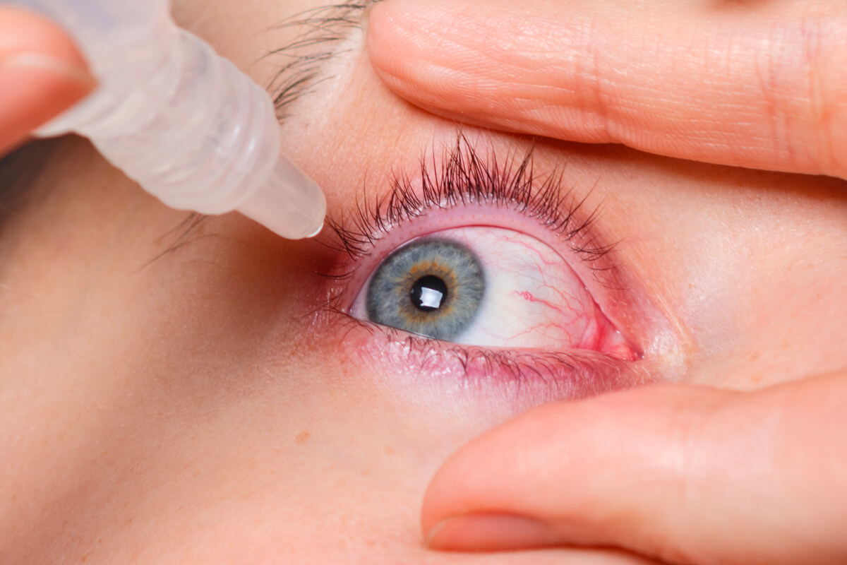 Sécheresse oculaire